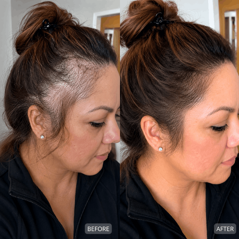 The Hair Loss Solution MarieClaire, New York Post, and 1,000+ Clinicians Are Talking About
